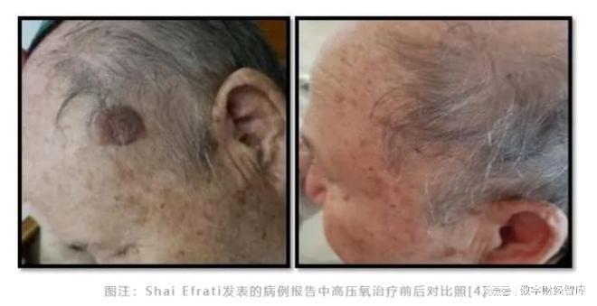 氧气立功！Aging研究发现：吸100％纯氧3个月，有效防治老年痴呆(2)